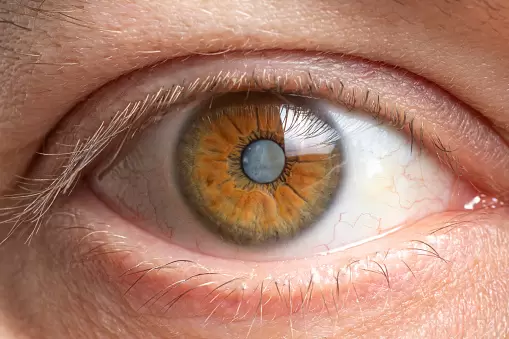 Cataract Eye
