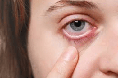 dry eye at Best Eye Hospital in Panipat