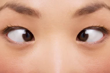 squint treatment at Best Eye Hospital in Panipat