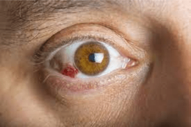 Corneal Ulcer at Best Eye Hospital in Panipat