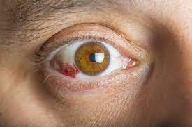 Corneal ulcer at Best Eye Hospital in Panipat