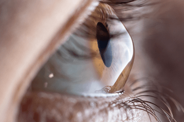 Keratoconus at Best Eye Hospital in Panipat