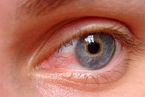 Pterygium at Best Eye Hospital in Panipat