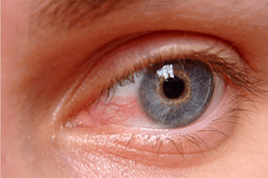 Pterygium at Best Eye Hospital in Panipat