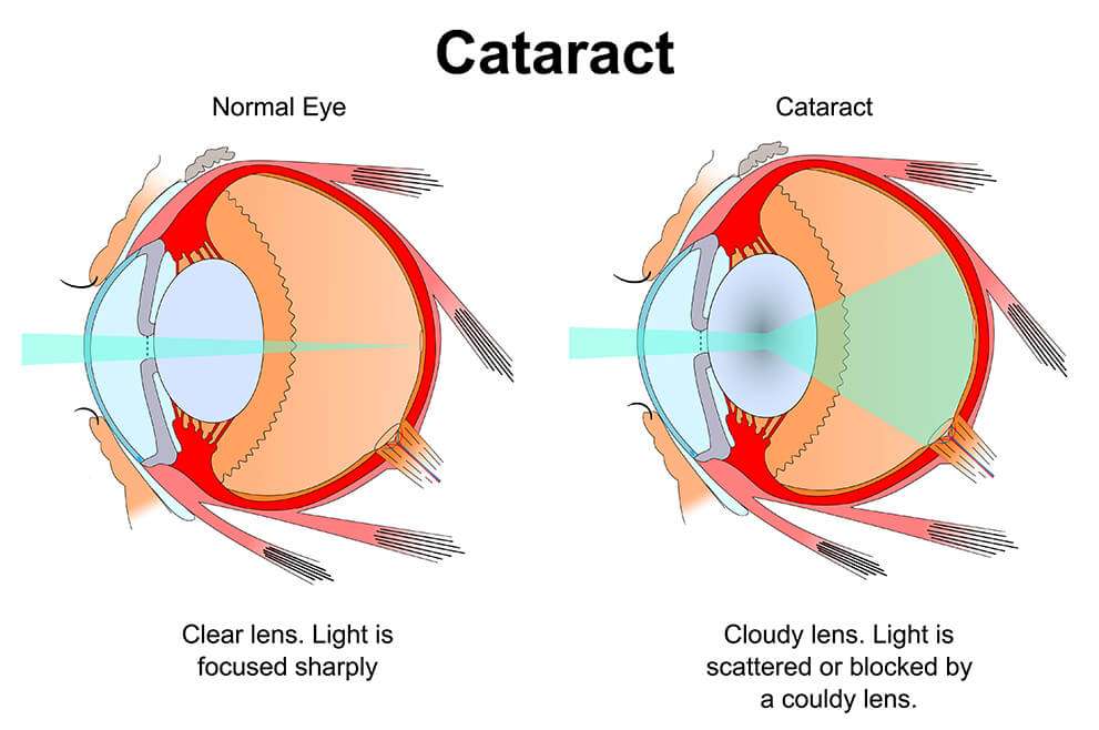 Cataract Eye and Normal Eye