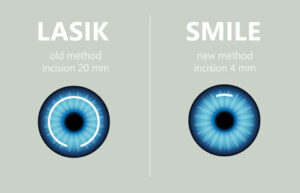 Lasik Smile at Best Eye Hospital in Panipat