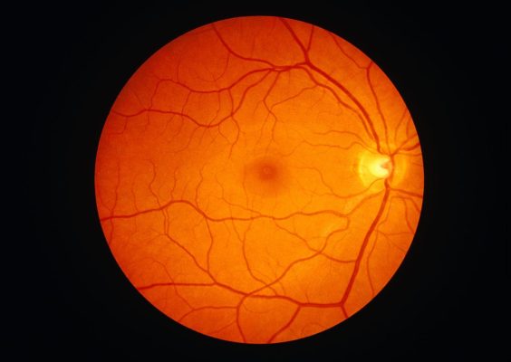 retina at Best Eye Hospital in Panipat